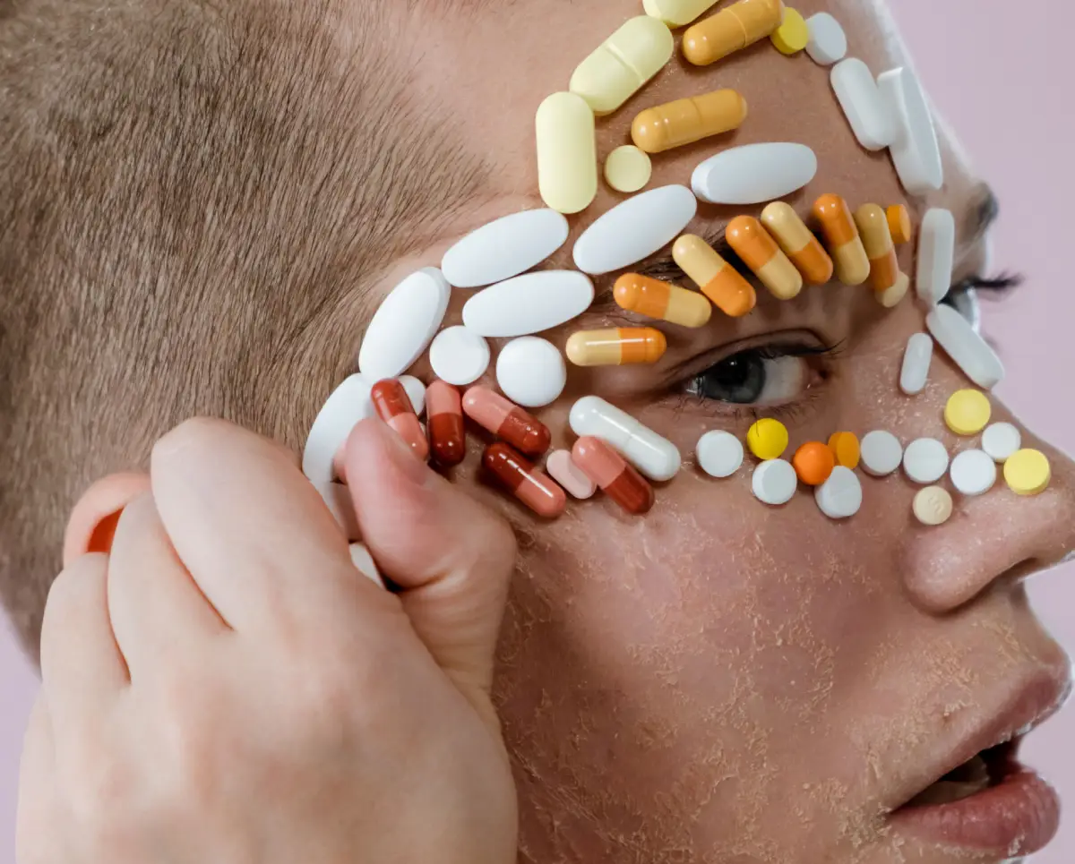 Accutane: o que a ciência diz sobre manchas e hiperpigmentação